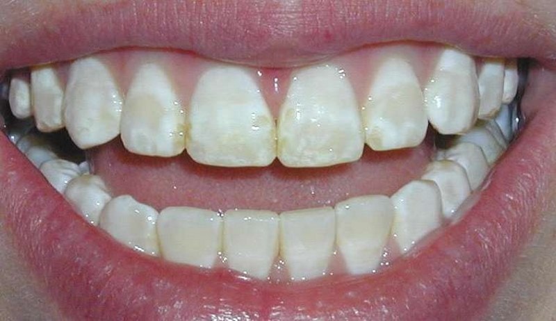 Đốm trắng đục xuất hiện là hiện tượng bị mòn men răng