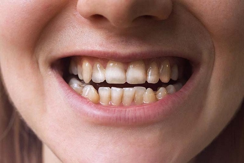Răng xỉn màu sang vàng khi bị mất men răng bảo vệ
