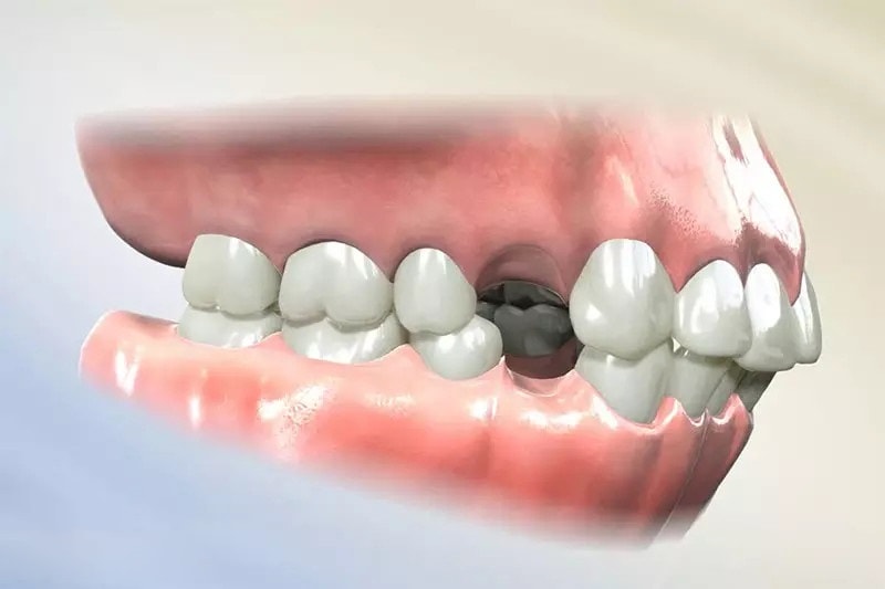 Mất răng số 4 hàm trên có ảnh hưởng gì không, có nguy hiểm không? 3
