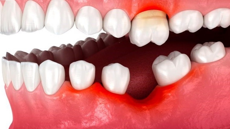 Giải đáp mất răng hàm dưới có sao không? Nguyên nhân - cách khắc phục 4